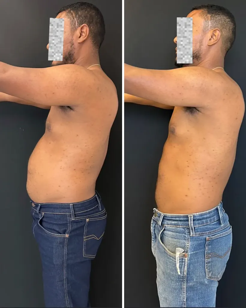 Antes e depois — caso 1